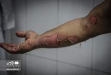 تصاویر دلخراش مصدومان چهارشنبه سوری  <img src="/images/picture_icon.png" width="11" height="10" border="0" align="top">